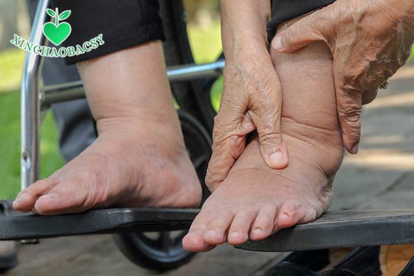 Sưng phù chân là triệu chứng của hẹp khít van 2 lá