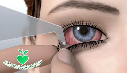 Miếng chèn mắt là thuốc chống khô mắt có tác dụng kéo dài trong vài giờ