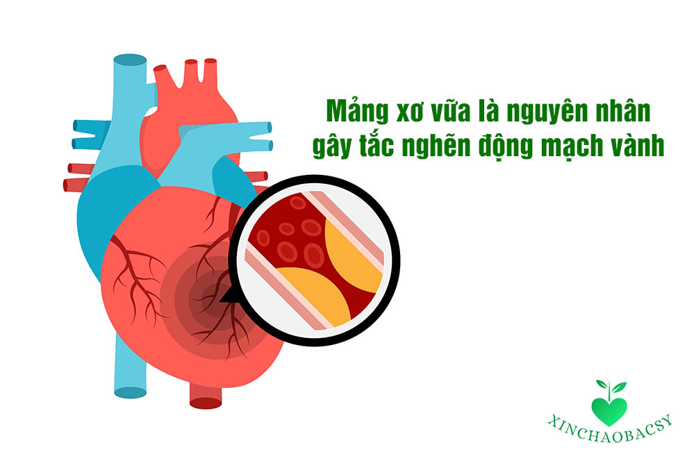 Bệnh mạch vành là tình trạng xuất hiện mảng xơ vữa bên trong lòng động mạch vành