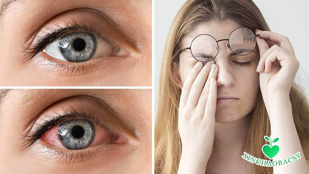 Khô mắt là nguyên nhân phổ biến gây mỏi mắt mờ mắt và đỏ rát mắt ở người trẻ