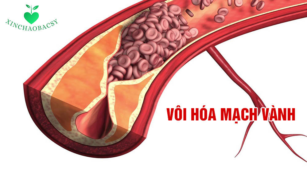 Vôi hóa mạch vành – Tiền đề của xơ vữa động mạch