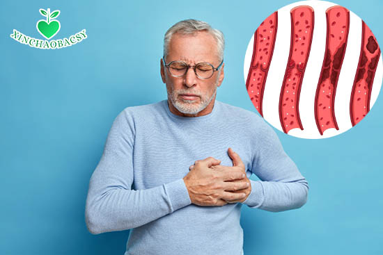 Mảng xơ vữa trong lòng mạch là nguyên nhân gây bệnh mạch vành