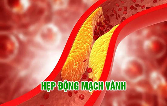 Hẹp động mạch vành là bệnh tim mạch nguy hiểm